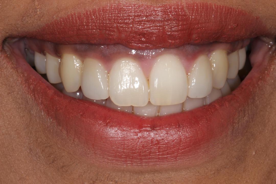 Lingual Brace Orthopedic Treatment from Dr Gurs Sehmi, London