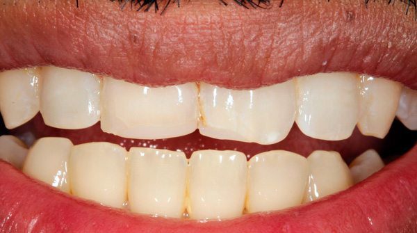 Teeth Straightening Hereford Dr Gurs Sehmi Cosmetic Dentist