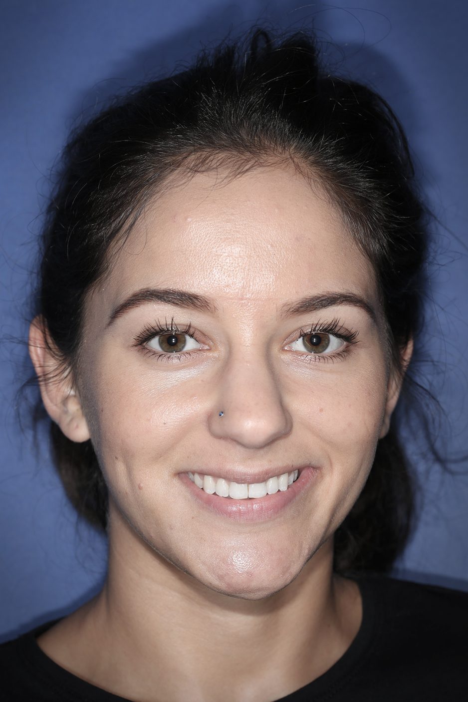 Lingual Brace Orthopedic Treatment from Dr Gurs Sehmi, London