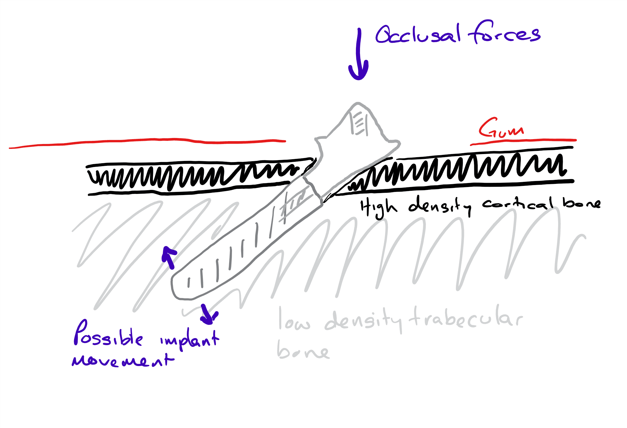 Implant Movement Dr Gurs Sehmi