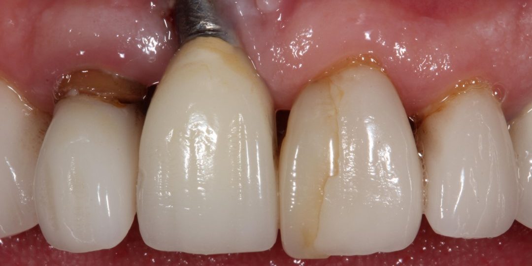 What Are the Lines on the Front of My Teeth? - Sure Dental