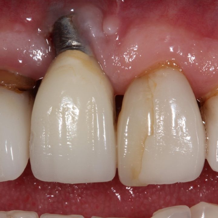 Introduction in to wire bending to finish orthodontic cases - Dr Gurs Sehmi