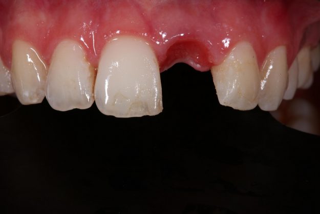 Introduction in to wire bending to finish orthodontic cases - Dr Gurs Sehmi