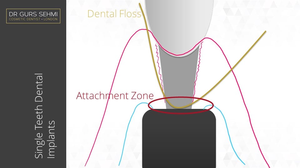 How to clean your All on 4 dental Implants Dr Gurs Sehmi