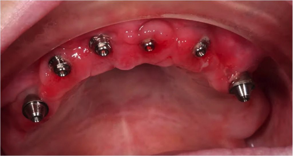 How painful is All-on-4 dental implants?