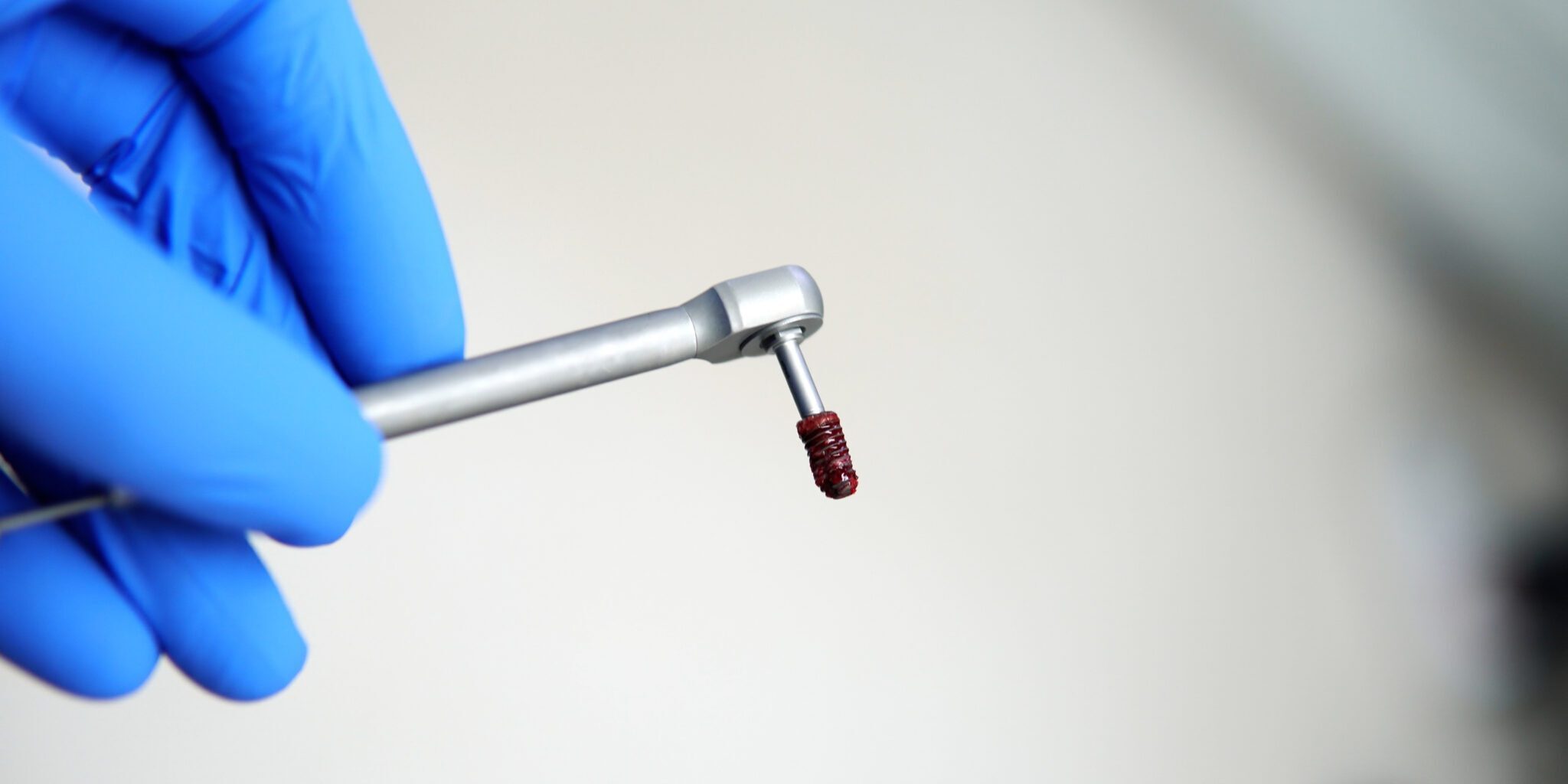 Can Dental Implants Be Removed? Dr Gurs Sehmi