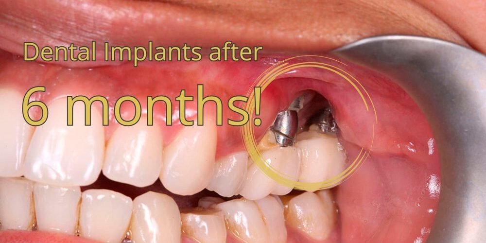 Dental implants Kent