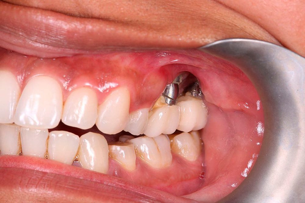 How Much to Get Dental Implants in Turkey  
