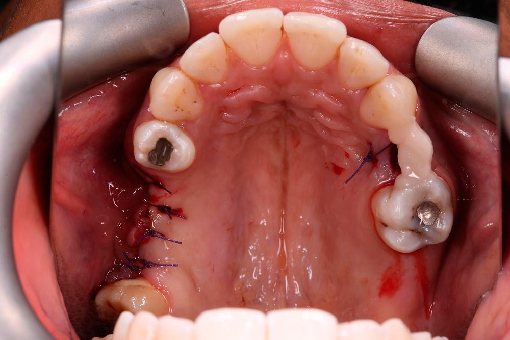 Removing Dental Implants Placed in Turkey Dr Gurs Sehmi